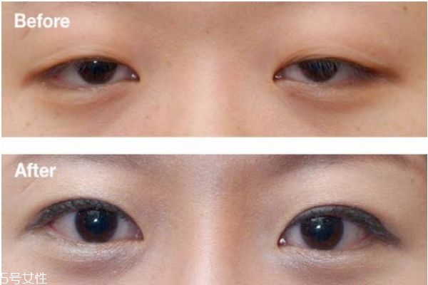 上瞼下垂矯正術(shù)治療方式 上瞼下垂矯正術(shù)優(yōu)點(diǎn)和缺點(diǎn) 上瞼下垂矯正術(shù)治療方式 上瞼下垂矯正術(shù)優(yōu)點(diǎn)和缺點(diǎn)