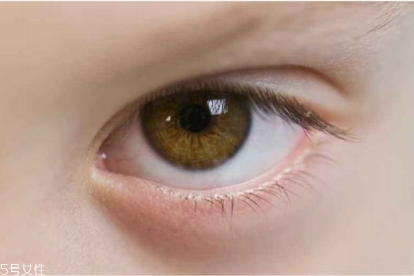如何判斷自己有上瞼下垂 上瞼下垂如何預(yù)防 如何判斷自己有上瞼下垂 上瞼下垂如何預(yù)防