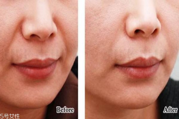 法令紋填充前后照片 填充法令紋后悔死 法令紋填充前后照片 填充法令紋后悔死