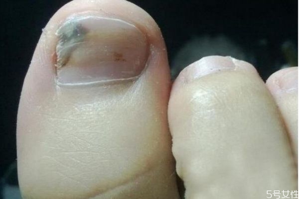 灰指甲是怎么造成的呢 應該怎么治療灰指甲呢 灰指甲是怎么造成的呢 應該怎么治療灰指甲呢