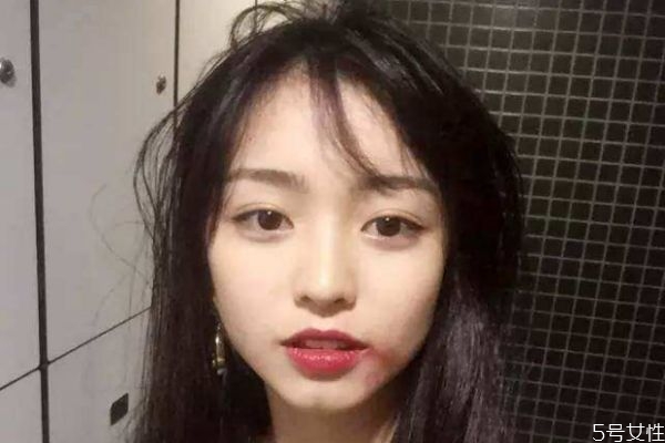 開內(nèi)眼角疤痕怎么消除 開內(nèi)眼角用哪些祛疤膏能消除疤痕 開內(nèi)眼角疤痕怎么消除 開內(nèi)眼角用哪些祛疤膏能消除疤痕