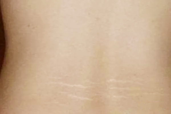 瘦了肥胖紋會(huì)消失嗎 肥胖紋怎么消除 瘦了肥胖紋會(huì)消失嗎 肥胖紋怎么消除