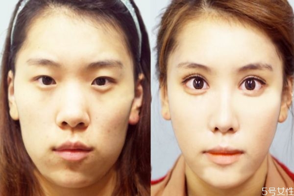 什么人群不能做去腫眼泡手術呢 做這種手術有副作用嗎 什么人群不能做去腫眼泡手術呢 做這種手術有副作用嗎