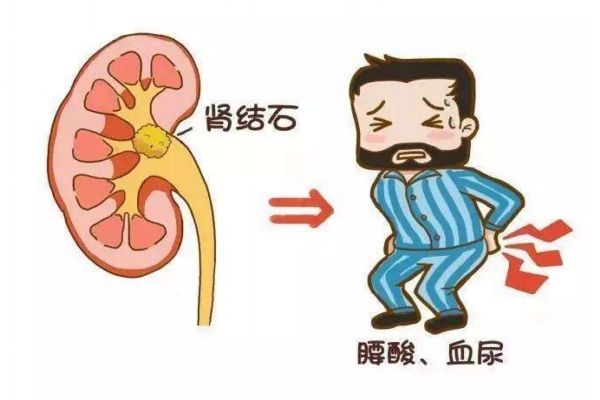 腎結石是一種什么病呢 腎結石的造成原因是什么呢 腎結石是一種什么病呢 腎結石的造成原因是什么呢