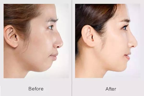 自體脂肪豐下巴好不好 自體脂肪豐下巴效果怎么樣 自體脂肪豐下巴好不好 自體脂肪豐下巴效果怎么樣