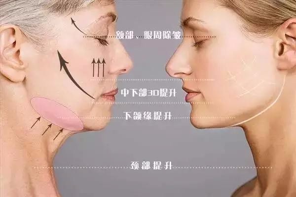 吸脂后皮膚松弛怎么辦 吸脂后怎么防止皮膚松弛 吸脂后皮膚松弛怎么辦 吸脂后怎么防止皮膚松弛