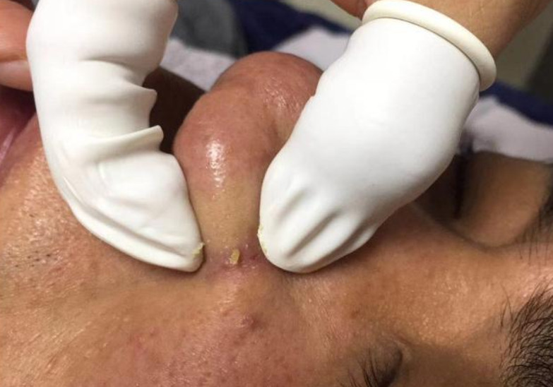 粉刺針挑痘痘還會長嗎 針清痘痘真的能好嗎 粉刺針挑痘痘還會長嗎 針清痘痘真的能好嗎