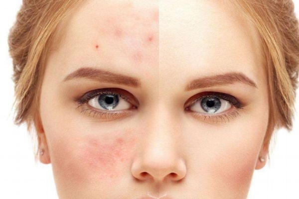 刷酸會(huì)爛臉嗎 應(yīng)該怎么正確刷酸呢 刷酸會(huì)爛臉嗎 應(yīng)該怎么正確刷酸呢