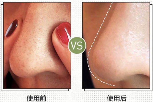 阿芙荷荷巴油去黑頭有效嗎 阿芙荷荷巴油去黑頭步驟 阿芙荷荷巴油去黑頭有效嗎 阿芙荷荷巴油去黑頭步驟