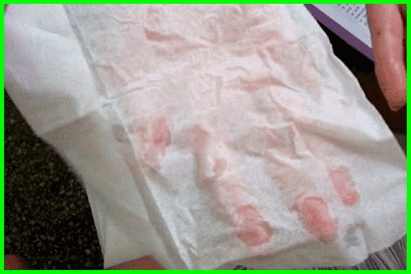 多汗癥是什么 多汗癥出汗程度怎么分級的 多汗癥是什么 多汗癥出汗程度怎么分級的