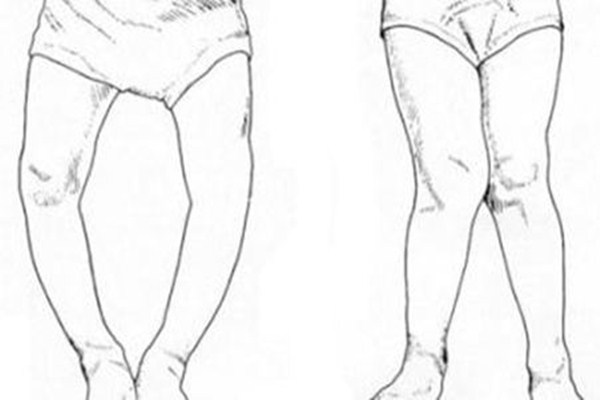 為什么會導致佝僂病 佝僂病前期癥狀有哪些 為什么會導致佝僂病 佝僂病前期癥狀有哪些