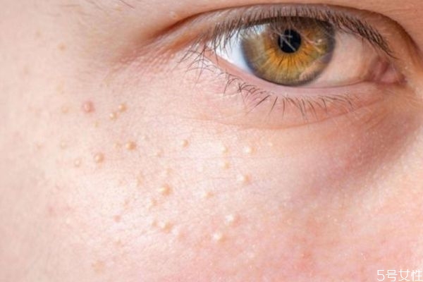 脂肪粒是不是閉口 脂肪粒是不是營(yíng)養(yǎng)過(guò)剩