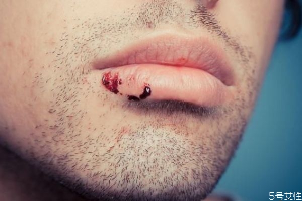 唇炎可以怎么治療呢 唇炎根治的方法有什么呢 唇炎可以怎么治療呢 唇炎根治的方法有什么呢