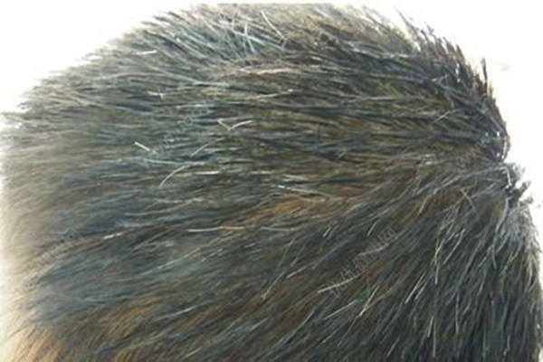 有白頭發(fā)拔了有害嗎 少年白吃什么可以調(diào)理 有白頭發(fā)拔了有害嗎 少年白吃什么可以調(diào)理