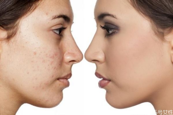 什么導(dǎo)致臉上毛孔變大 導(dǎo)致毛孔變大的主要因素 什么導(dǎo)致臉上毛孔變大 導(dǎo)致毛孔變大的主要因素