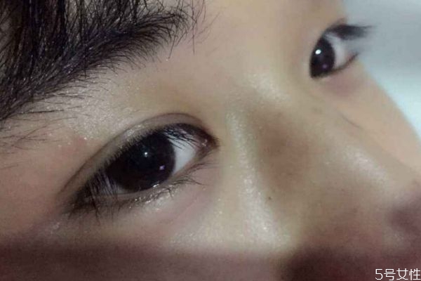 割雙眼皮可能有什么危害呢 割雙眼皮要注意什么呢 割雙眼皮可能有什么危害呢 割雙眼皮要注意什么呢