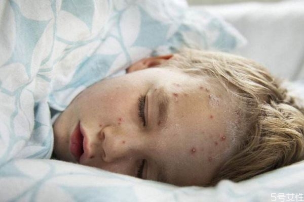 天花是一種什么疾病呢 得天花的癥狀有什么呢 天花是一種什么疾病呢 得天花的癥狀有什么呢