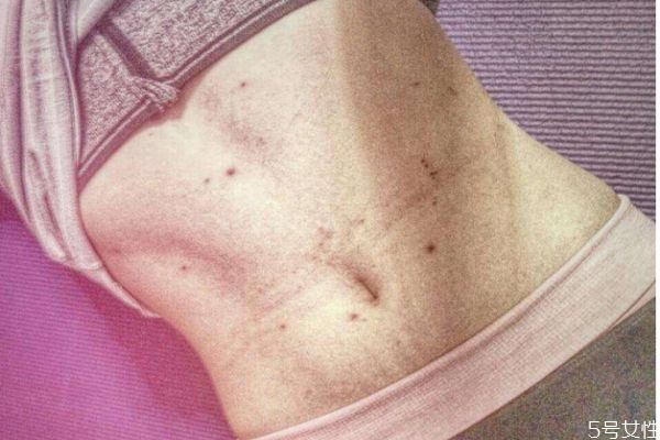 天花是怎么造成的呢 造成天花的原因有什么呢 天花是怎么造成的呢 造成天花的原因有什么呢