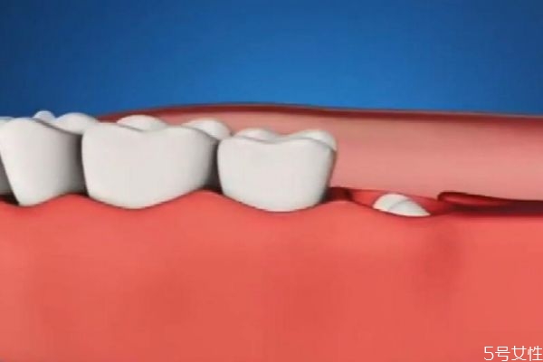 拔智齒有什么危害嗎 什么人群需要拔智齒呢 拔智齒有什么危害嗎 什么人群需要拔智齒呢