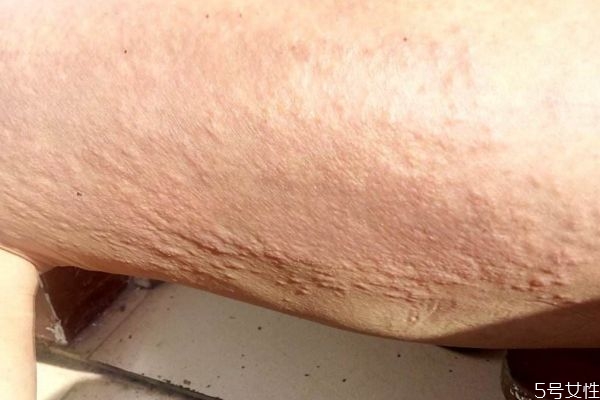 痱子是怎么造成的呢 為什么會有痱子呢 痱子是怎么造成的呢 為什么會有痱子呢