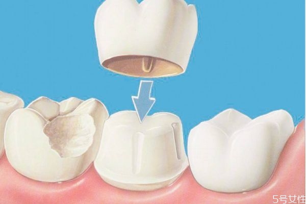 美容冠矯正有什么作用 美容冠矯正多少錢 美容冠矯正有什么作用 美容冠矯正多少錢