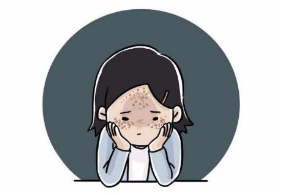 修正祛斑霜真的能去掉臉上的斑嗎 修正祛斑霜真的管用嗎