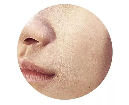 臉上化妝的地方起皮怎么辦 皮膚起皮怎么護理 臉上化妝的地方起皮怎么辦 皮膚起皮怎么護理