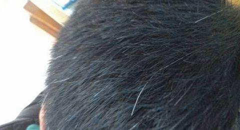 焦慮會長白頭發(fā)嗎 白頭發(fā)如何預防 焦慮會長白頭發(fā)嗎 白頭發(fā)如何預防