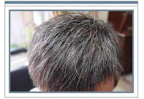 焦慮會長白頭發(fā)嗎 白頭發(fā)如何預防 焦慮會長白頭發(fā)嗎 白頭發(fā)如何預防