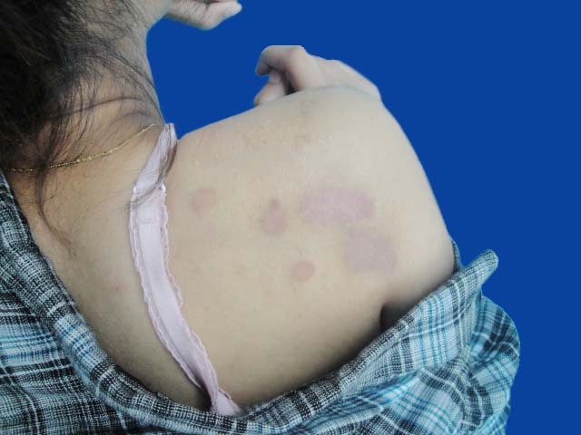 怎樣能防止傷口留疤 傷口留疤主要和什么有關(guān) 怎樣能防止傷口留疤 傷口留疤主要和什么有關(guān)