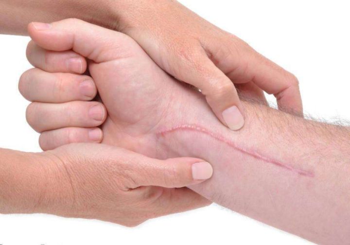 怎樣能防止傷口留疤 傷口留疤主要和什么有關(guān) 怎樣能防止傷口留疤 傷口留疤主要和什么有關(guān)