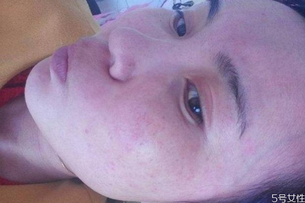 化妝品過敏可以自愈嗎 化妝品過敏如何治療 化妝品過敏可以自愈嗎 化妝品過敏如何治療