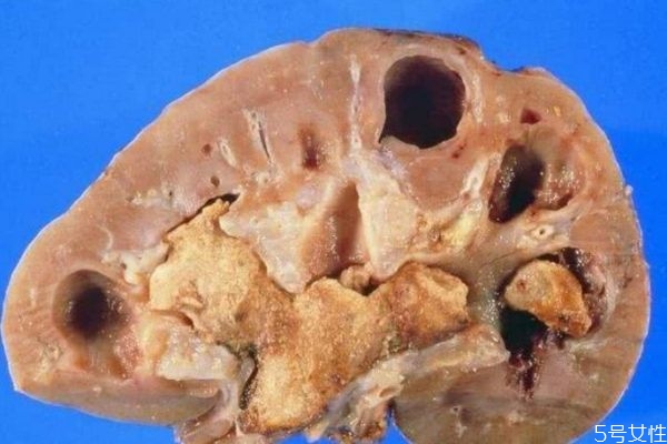 腎結(jié)石嚴(yán)重嗎 腎結(jié)石多大需要碎石 腎結(jié)石嚴(yán)重嗎 腎結(jié)石多大需要碎石