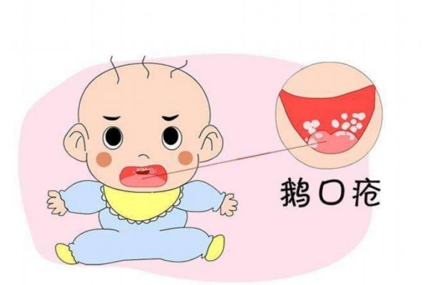 什么是鵝口瘡 鵝口瘡危害大嗎 什么是鵝口瘡 鵝口瘡危害大嗎