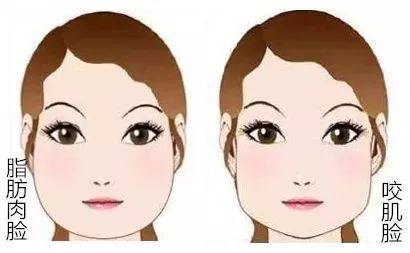 嬰兒肥會自己瘦嗎 咬肌肥大是天生的嗎 嬰兒肥會自己瘦嗎 咬肌肥大是天生的嗎