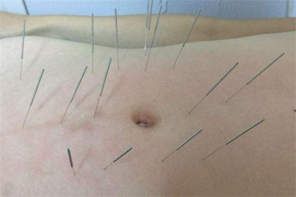 針灸減肥扎哪些部位 針灸減肥為什么會(huì)反彈 針灸減肥扎哪些部位 針灸減肥為什么會(huì)反彈