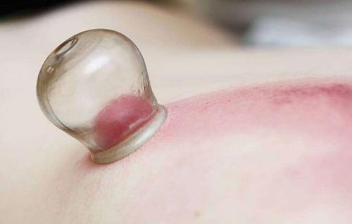 腹部拔罐減肥拔哪里 拔罐減肥包含哪些方法 腹部拔罐減肥拔哪里 拔罐減肥包含哪些方法