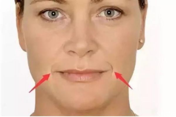 如何去除法令紋 去除法令紋的方法 如何去除法令紋 去除法令紋的方法