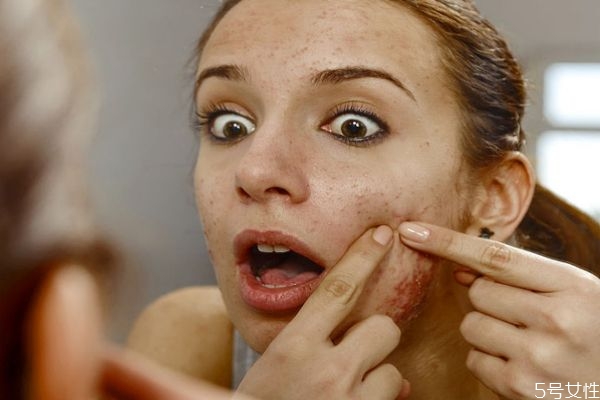 快速祛痘的方法 最快最有效的解決痘痘 快速祛痘的方法 最快最有效的解決痘痘