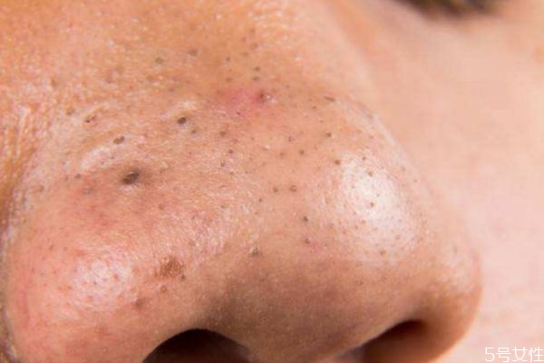 草莓鼻是怎么造成的 為什么會有草莓鼻 草莓鼻是怎么造成的 為什么會有草莓鼻