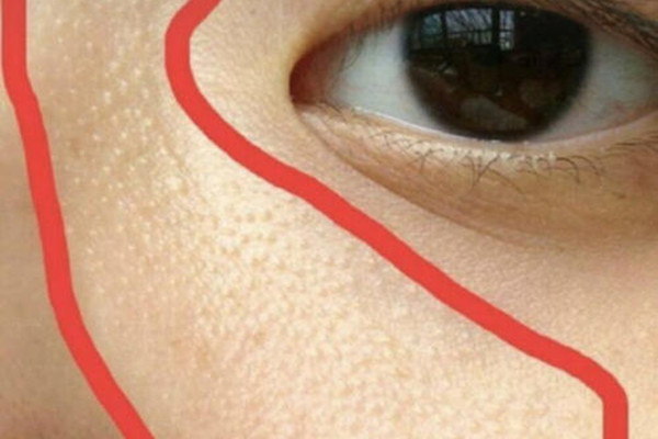 毛周角化和脂肪粒的區(qū)別 毛周角化和脂肪粒有什么不一樣 毛周角化和脂肪粒的區(qū)別 毛周角化和脂肪粒有什么不一樣