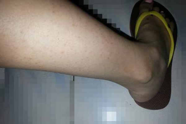 毛角周化好發(fā)于什么年齡 毛角周化什么年齡容易長 毛角周化好發(fā)于什么年齡 毛角周化什么年齡容易長