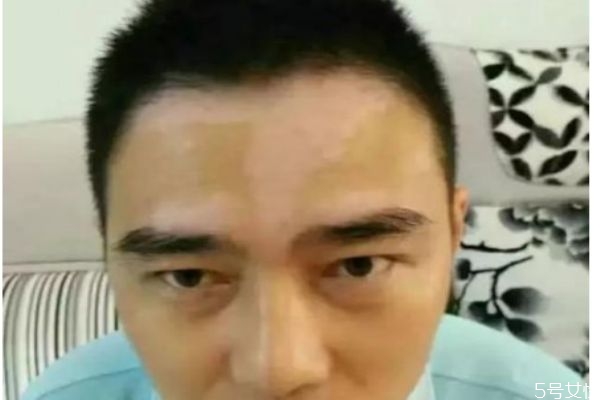 白癩風(fēng)是怎么造成的 為什么會(huì)形成白癩風(fēng) 白癩風(fēng)是怎么造成的 為什么會(huì)形成白癩風(fēng)