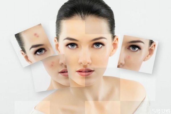 針清痘痘后多久會(huì)好 針清的注意事項(xiàng) 針清痘痘后多久會(huì)好 針清的注意事項(xiàng)