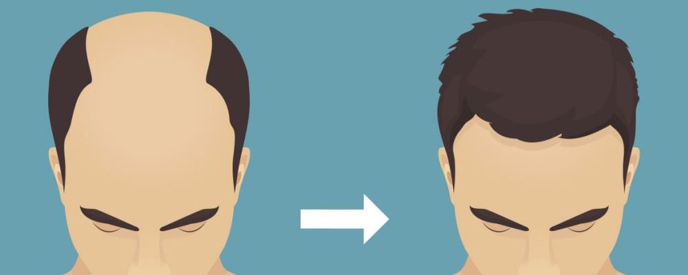 自體毛發(fā)種植的原理 自體毛發(fā)種植的特點(diǎn) 自體毛發(fā)種植的原理 自體毛發(fā)種植的特點(diǎn)