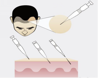 自體毛發(fā)種植多少錢 自體毛發(fā)種植哪一步最關(guān)鍵 自體毛發(fā)種植多少錢 自體毛發(fā)種植哪一步最關(guān)鍵