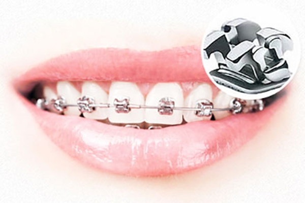 牙縫大能做矯正嗎 牙齒矯正后要注意什么 牙縫大能做矯正嗎 牙齒矯正后要注意什么