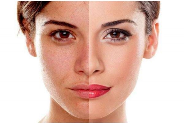 油性皮膚造成的原因 為什么會產(chǎn)生油性皮膚 油性皮膚造成的原因 為什么會產(chǎn)生油性皮膚