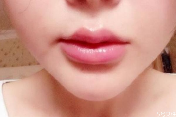 打完嘟嘟唇多久能變的自然 打完嘟嘟唇多久定型 打完嘟嘟唇多久能變的自然 打完嘟嘟唇多久定型