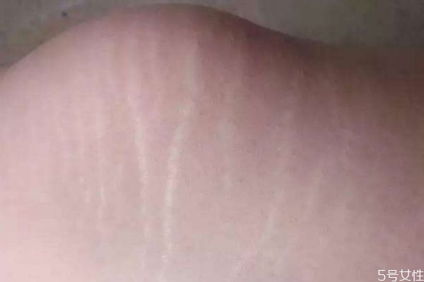 青春期生長紋如何消除 青春期生長紋消除方法 青春期生長紋如何消除 青春期生長紋消除方法